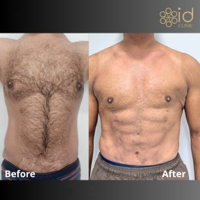 before-after photo abdominalnoe-travlenie