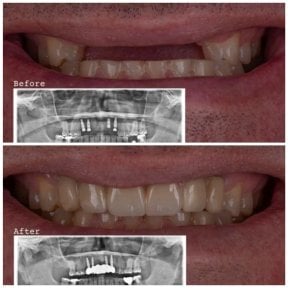 Résultat avant/après implants All-on-4 à DENTAL CLINIC SHTERN, sourire restauré