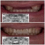 Résultat avant/après implants All-on-4 à DENTAL CLINIC SHTERN, sourire restauré