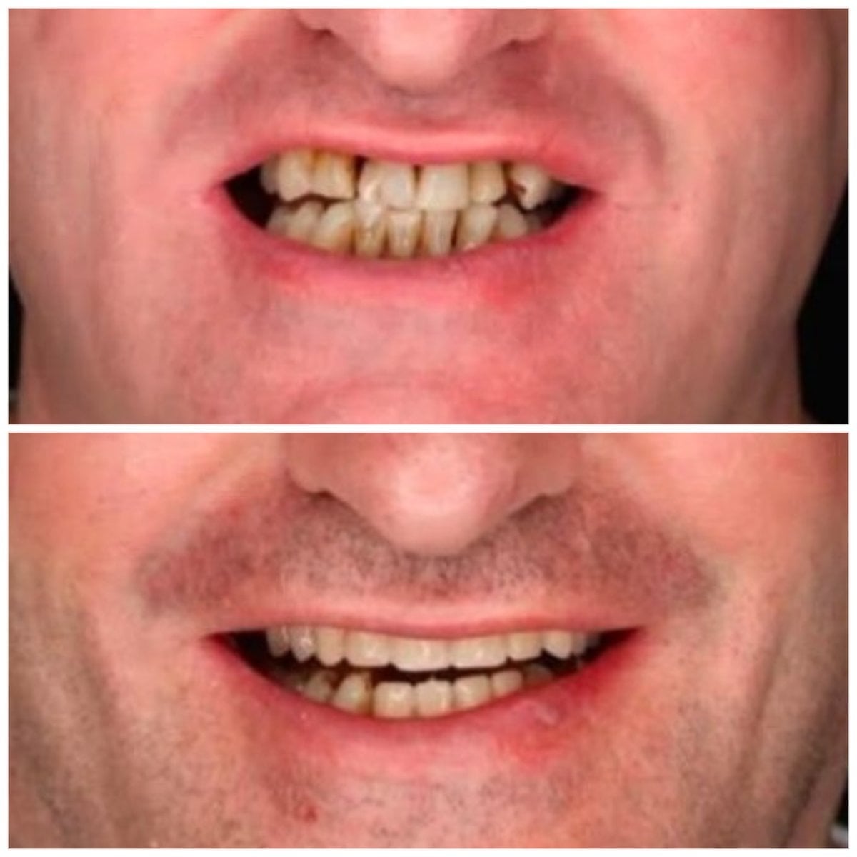 نتيجة قبل وبعد زراعة الأسنان All-on-4 في DENTAL CLINIC SHTERN، ابتسامة محسنة