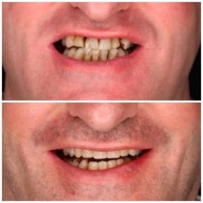 Résultat avant/après implants All-on-4 à DENTAL CLINIC SHTERN, sourire amélioré