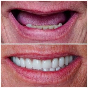 Résultat avant/après implants All-on-4 à DENTAL CLINIC SHTERN, restauration du sourire