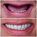 Résultat avant/après implants All-on-4 à DENTAL CLINIC SHTERN, restauration du sourire
