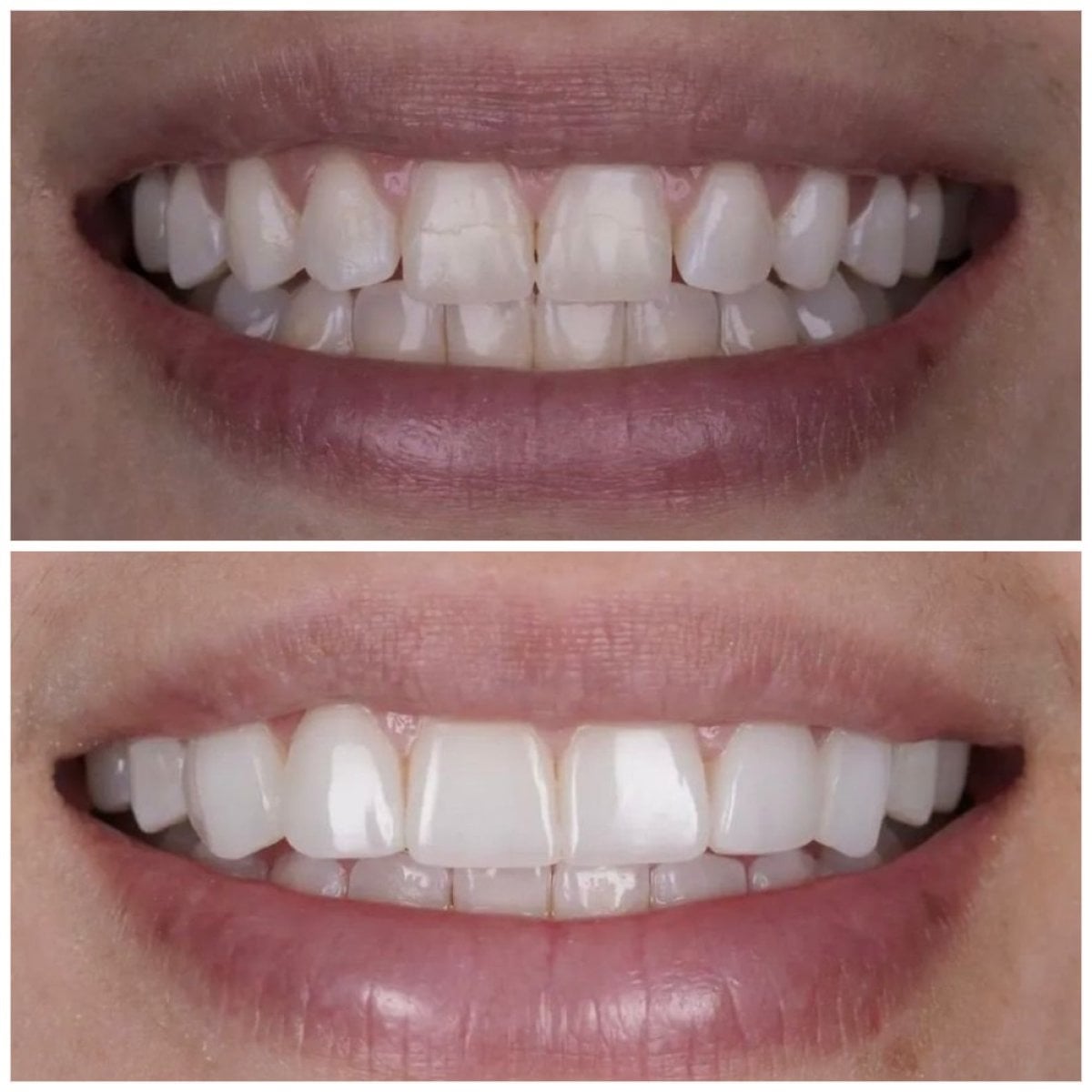 Resultados antes y después de carillas sin tallado en DENTAL CLINIC SHTERN, transformación de sonrisa