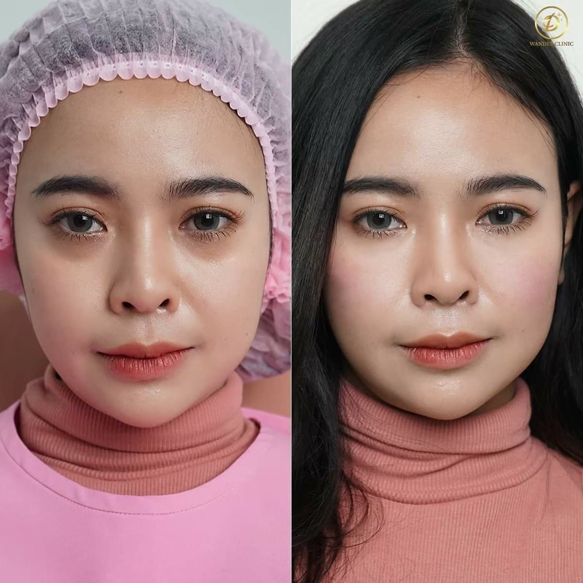 Antes y después de rellenos en Wander Clinic: mayor volumen y contorno facial