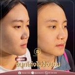 نتائج عملية تجميل الأنف قبل وبعد في عيادة واندي، تحسين شكل الأنف والملف الجانبي