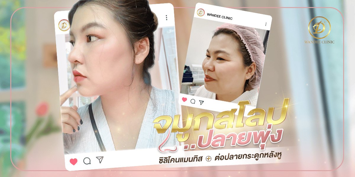 نتائج تجميل الأنف قبل وبعد في WANDEE CLINIC، إعادة تشكيل الأنف بمظهر طبيعي