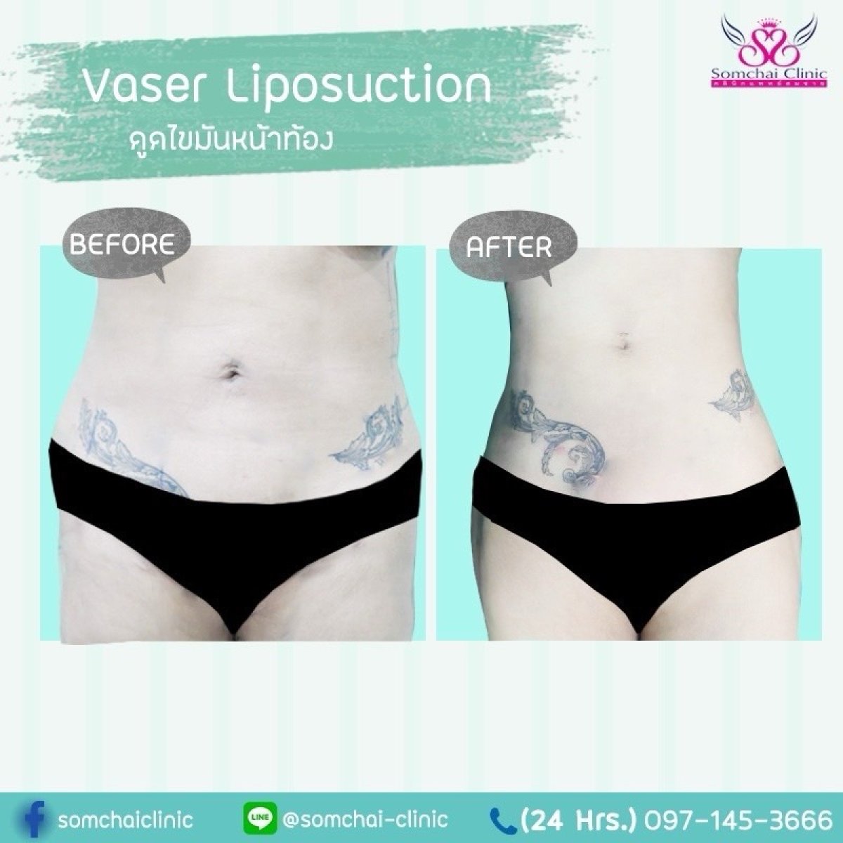 Resultados antes y después de liposucción Vaser en abdomen en Somchai Clinic – contorno más delgado