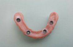 Prótesis dental All-on-4 en SoftDentalCare Clinic, resultado de restauración avanzada