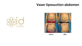 Before and after Vaser liposuction abdomen results at ID Clinic Bangkok, visible fat reduction