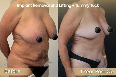 before-after photo mastopexy-breast-lift-contour-plastics