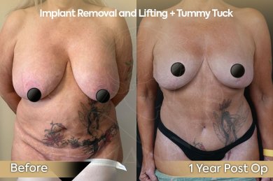 before-after photo mastopexy-breast-lift-contour-plastics