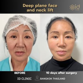 before-after photo tightening-of-facial-skin-facelift