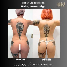 before-after photo vaser-liposuction