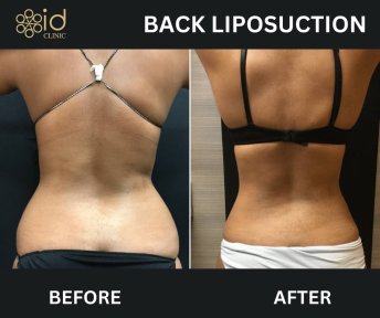 before-after photo vaser-liposuction