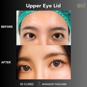 before-after photo upper-and-lower-eyelid-surgery