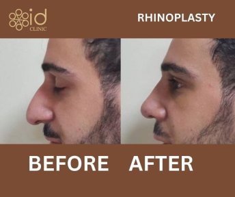 before-after photo rhinoplasty-nose-job