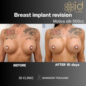 before-after photo breast-augmentation
