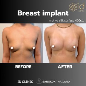 before-after photo breast-augmentation