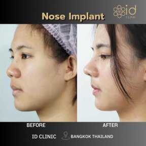 before-after photo rhinoplasty-nose-job