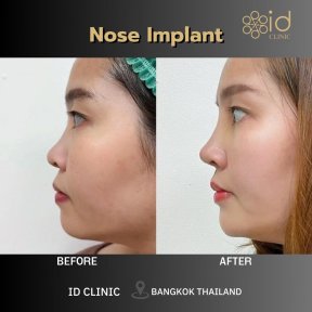 before-after photo rhinoplasty-nose-job