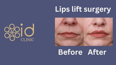 before-after photo lip-lift