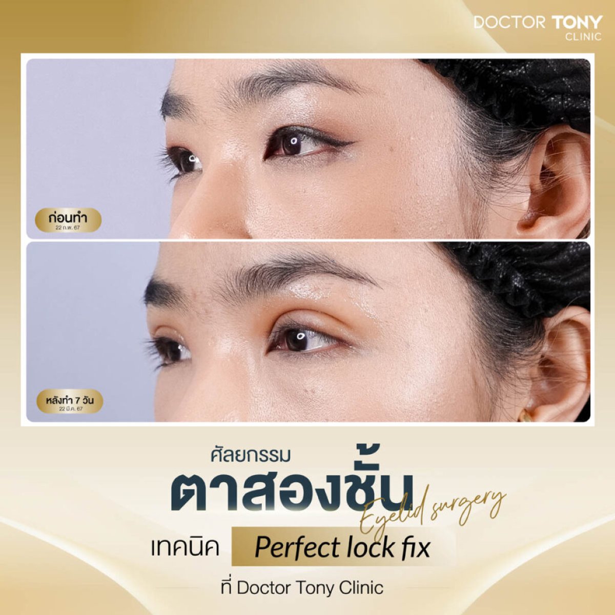 نتائج جراحة الجفن العلوي قبل وبعد في Doctor Tony Clinic – تحسين شكل الجفن