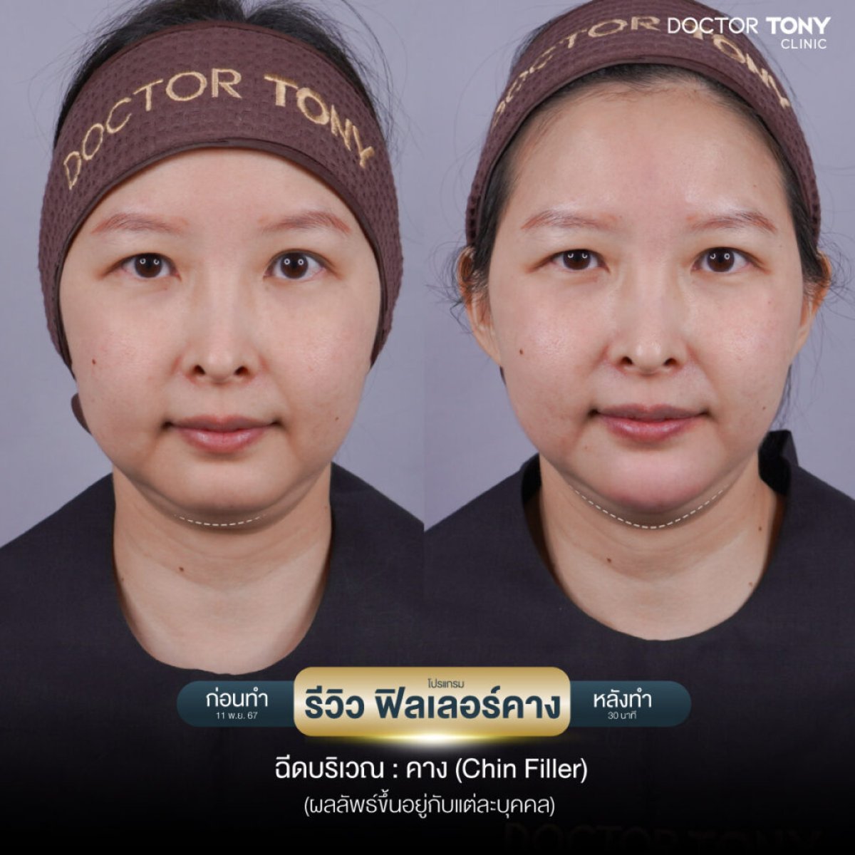 Resultados de antes y después de relleno de mentón masculino en Doctor Tony Clinic