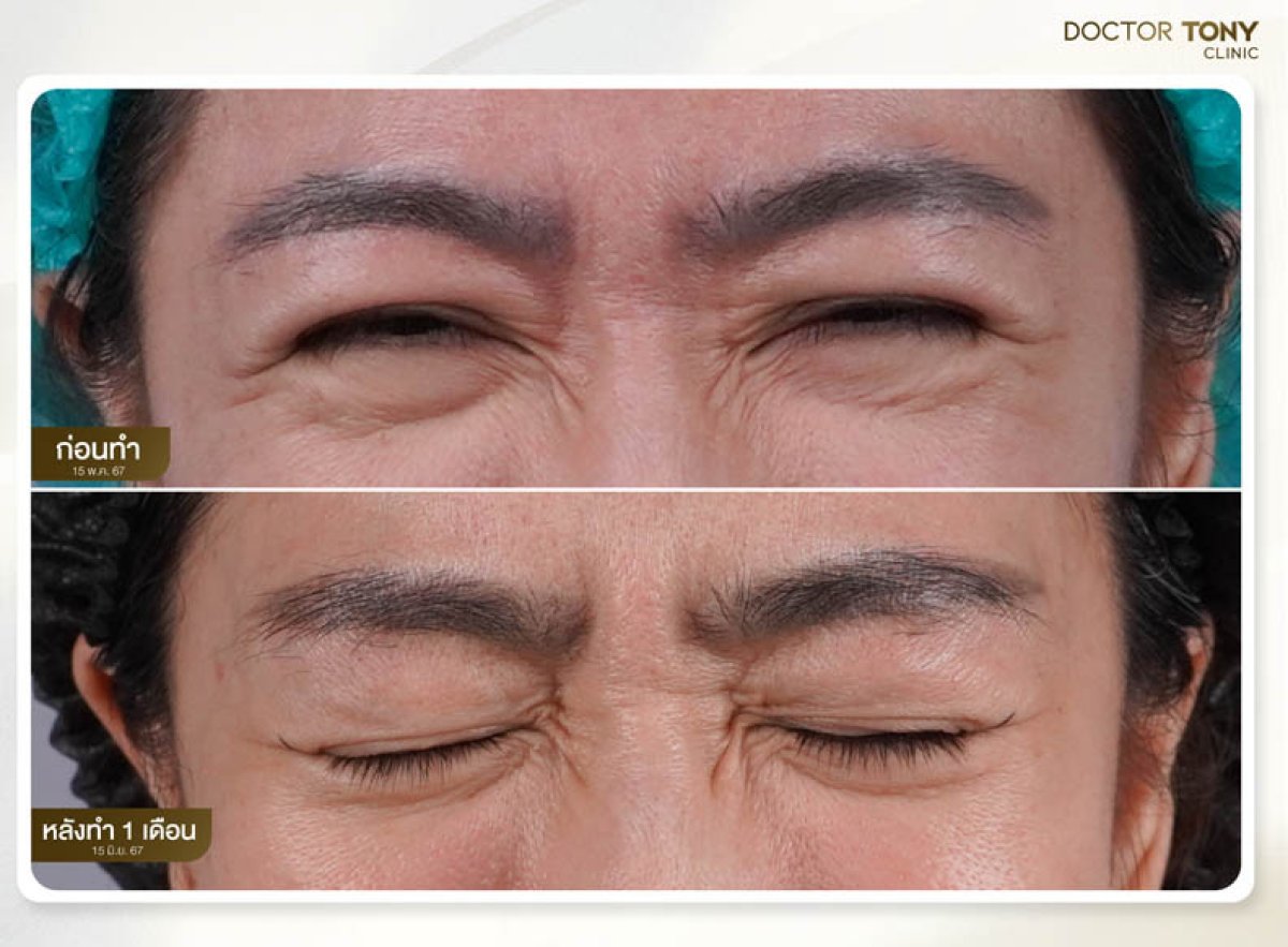 Antes y después de botox en la frente en Doctor Tony Clinic, resultado de alisado visible