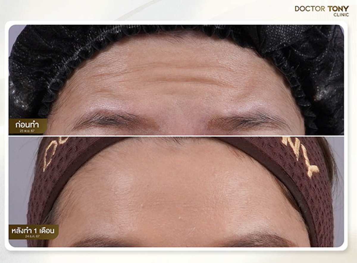 Resultados de botox para arrugas en Doctor Tony Clinic: frente más lisa tras 1 mes