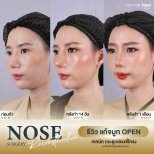 نتائج عملية تجميل الأنف قبل وبعد في عيادة دكتور توني، تحسين واضح لشكل الأنف
