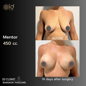 before-after photo rhinoplasty-nose-job