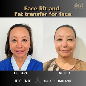 before-after photo deep-plane-facelift