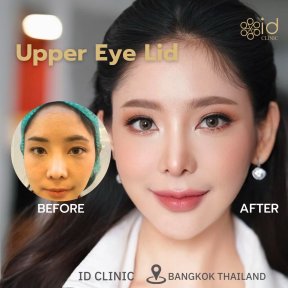 before-after photo deep-plane-facelift