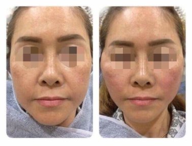 before-after photo botox-injections