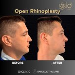 Before and after open rhinoplasty results at ID Clinic Bangkok, improved nose profile