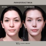 Before and after rhinoplasty results at VG Plastic Surgery – nose reshaping after 10 days
