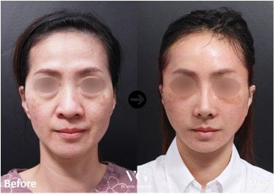 Before and after facelift results at VG Plastic Surgery – visible facial rejuvenation and lifting