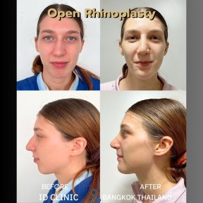 Before and after open rhinoplasty results at ID Clinic Bangkok, nose reshaping improvement