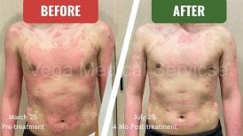 Before and after stem cell therapy for psoriasis at Vega Clinic, visible skin improvement result
