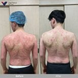 Before and after stem cell therapy for psoriasis at Vega Clinic, visible skin improvement result