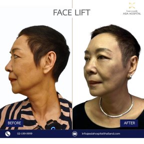 Результаты до и после подтяжки лица в Asia Cosmetic Hospital, видимое омоложение лица
