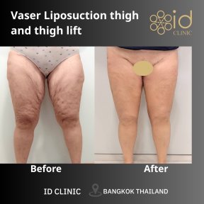 before-after photo abdominoplastika