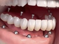 Résultat d’implant dentaire chez Punta Cana dentist odontologia familiar, restauration complète