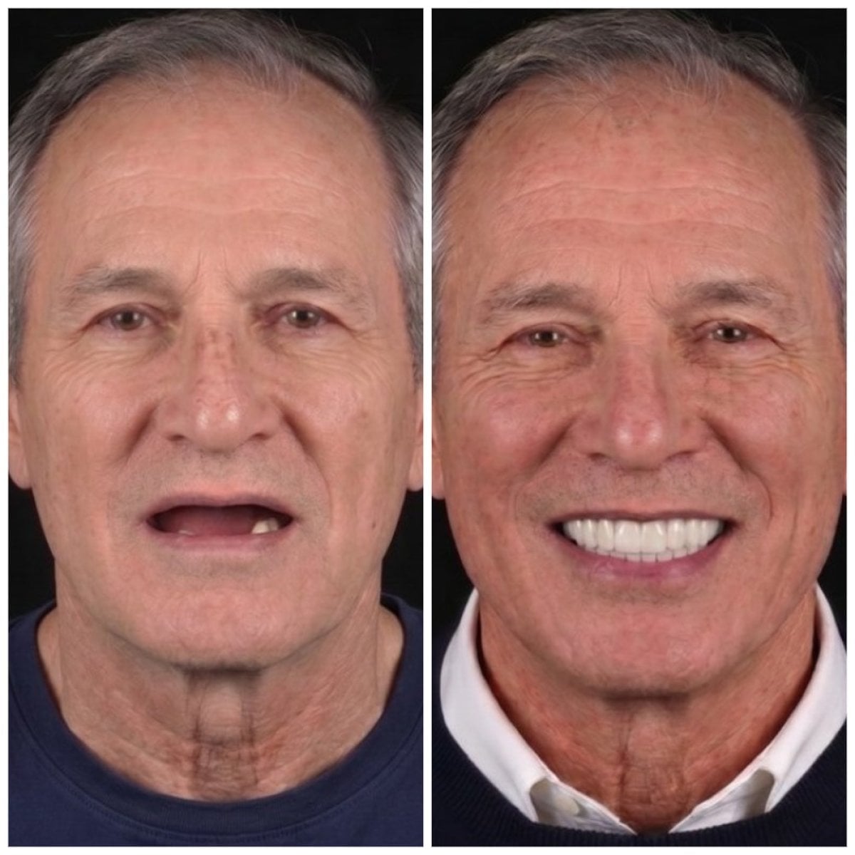 Resultados antes y después de implantes All-on-4 en VBright Dental – restauración total de sonrisa