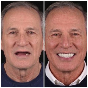 before-after photo all-on-4-dental-implants