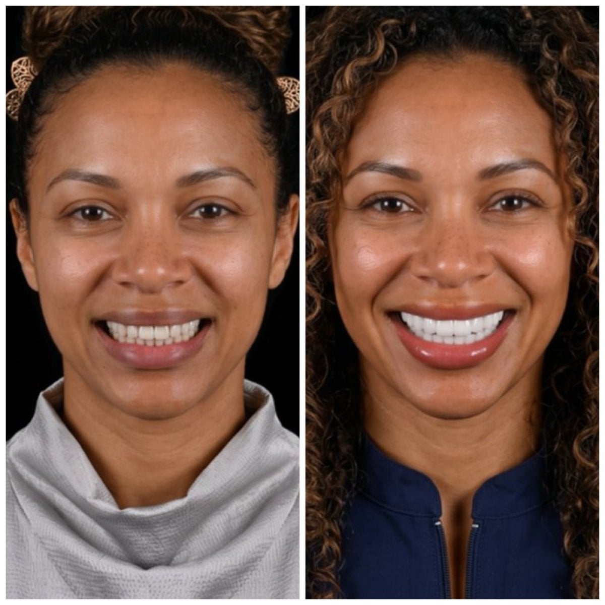 قبل وبعد قشور الأسنان في VBright Dental – نتائج تحول الابتسامة