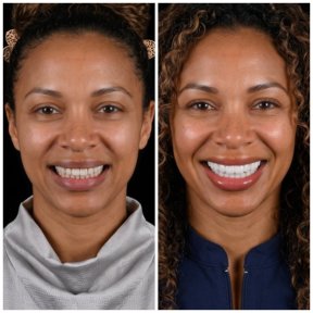 before-after photo installation-of-a-veneer