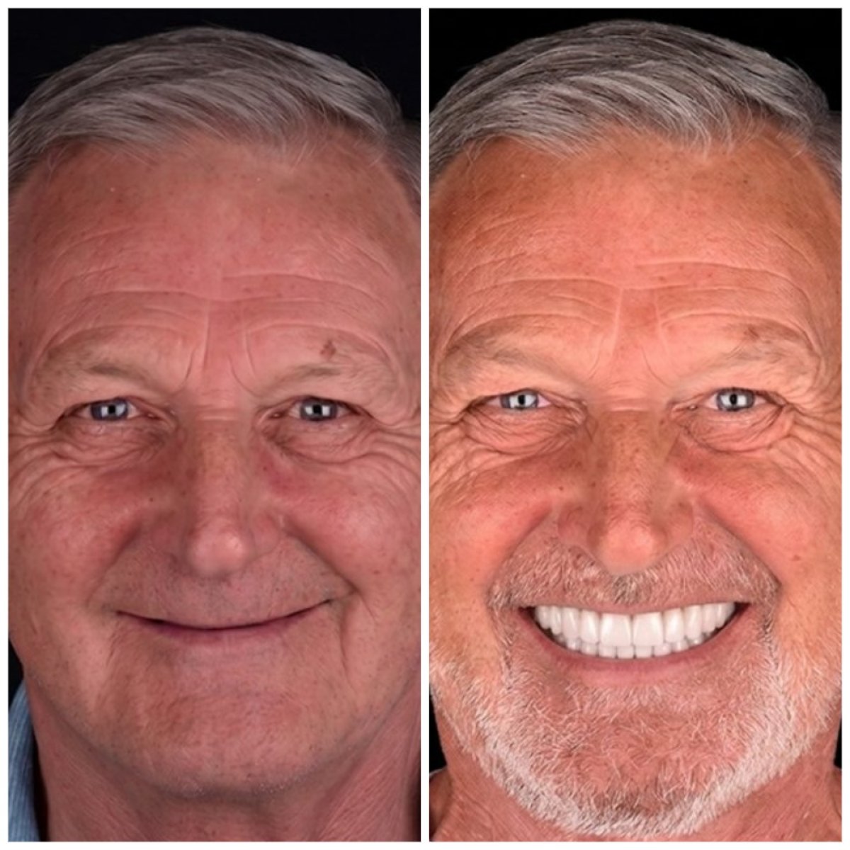 Resultados antes y después de implantes All-on-4 en VBright Dental – restauración total de sonrisa