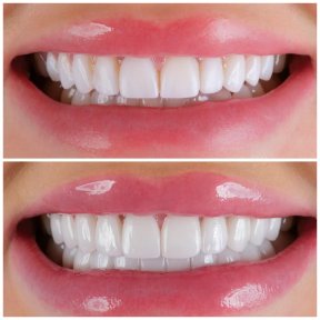before-after photo installation-of-a-veneer